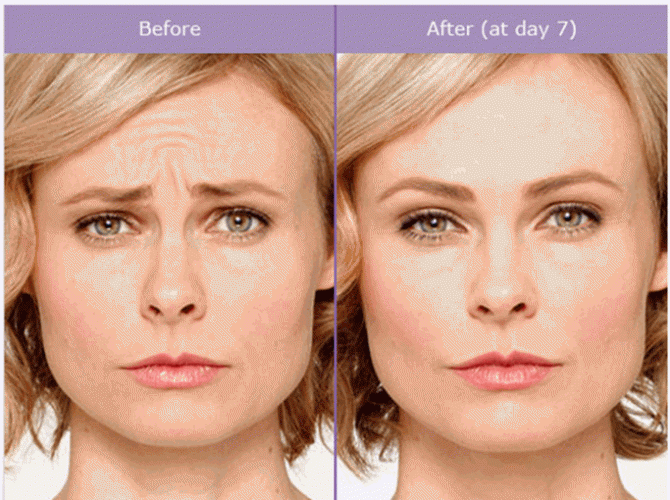 Botox-Before-and-After